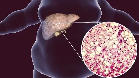 Journal of Hepatology: жировая болезнь печени угрожает здоровью мозга