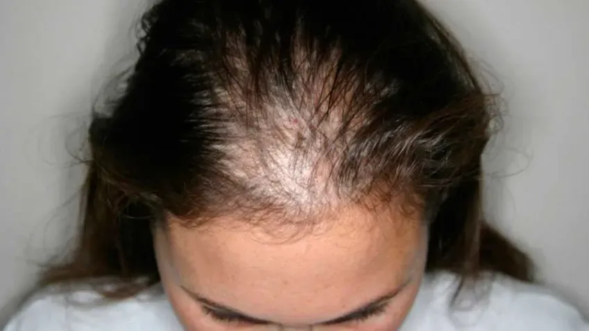 РГ: Около 9% россиян теряют волосы после 35 лет из-за генетической мутации