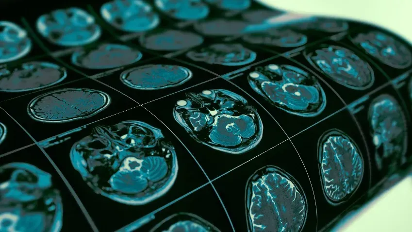 Ученые изучили факторы когнитивных нарушений при болезни Паркинсона