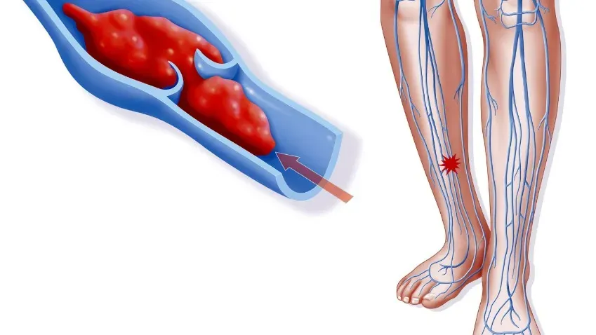 РИА «Новости»: Внезапная ноющая боль в ноге или руке может являться симптомом тромбоза