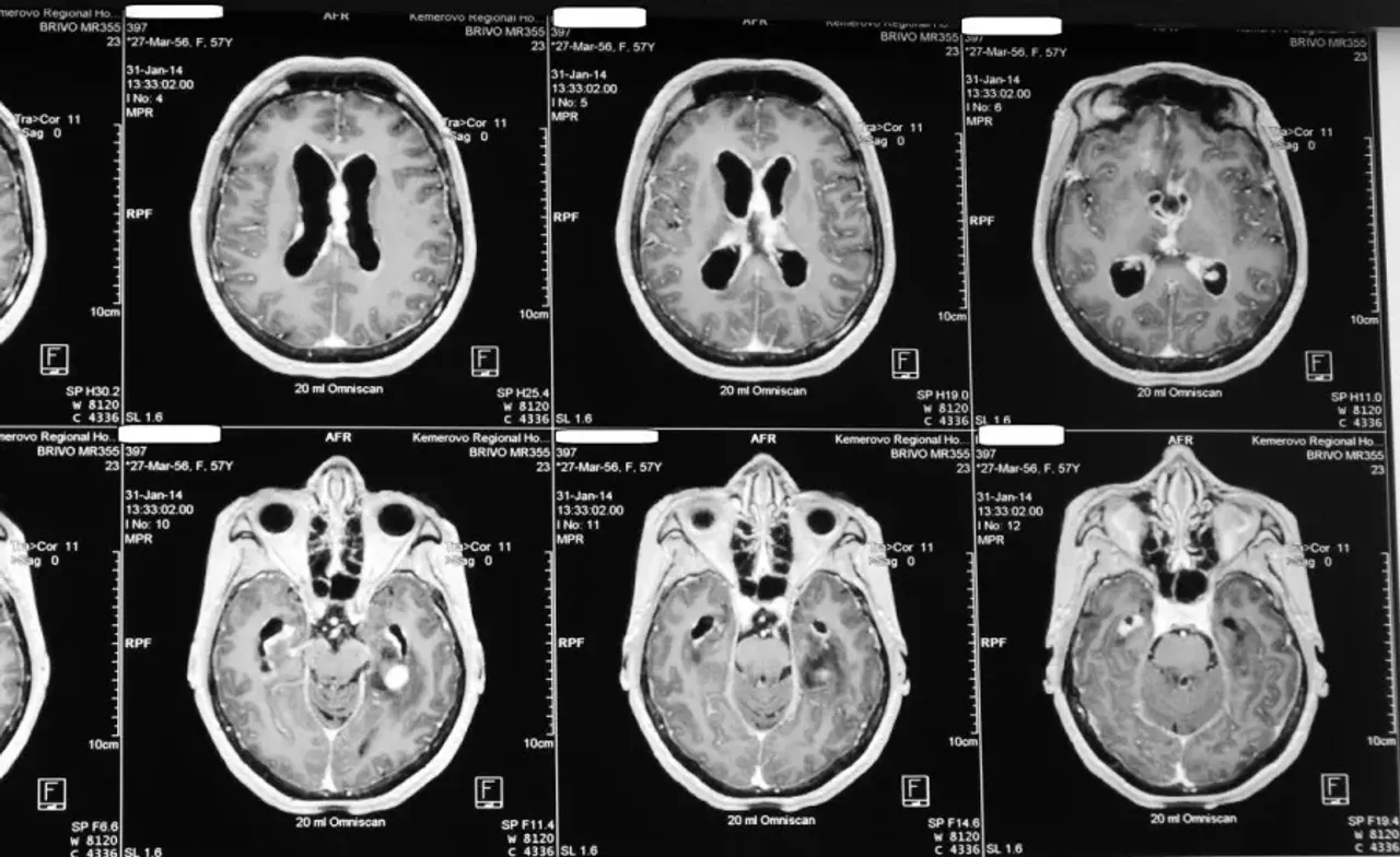 JAD: снотворные препараты почти на 80% повысили риск деменции у пожилых ...
