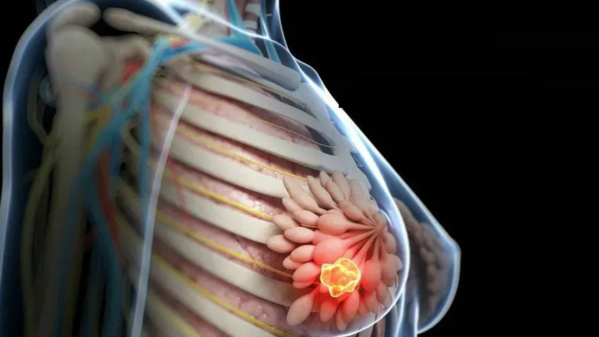 Medical Xpress: Рибоциклиб улучшает результаты гормонотерапии при раннем раке молочной железы