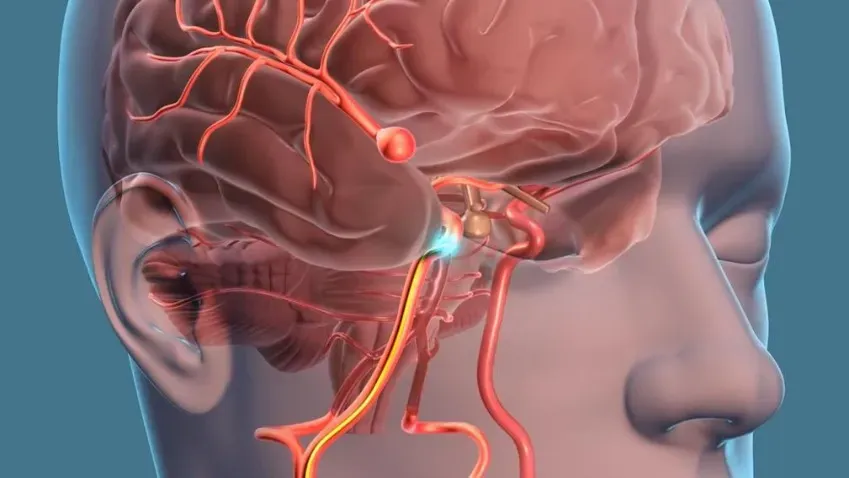 Ученые открыли новый способ лечения аневризмы головного мозга без операции