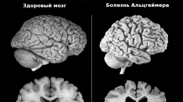 Ученые заявили, что изменение походки может быть маркером болезни Альцгеймера