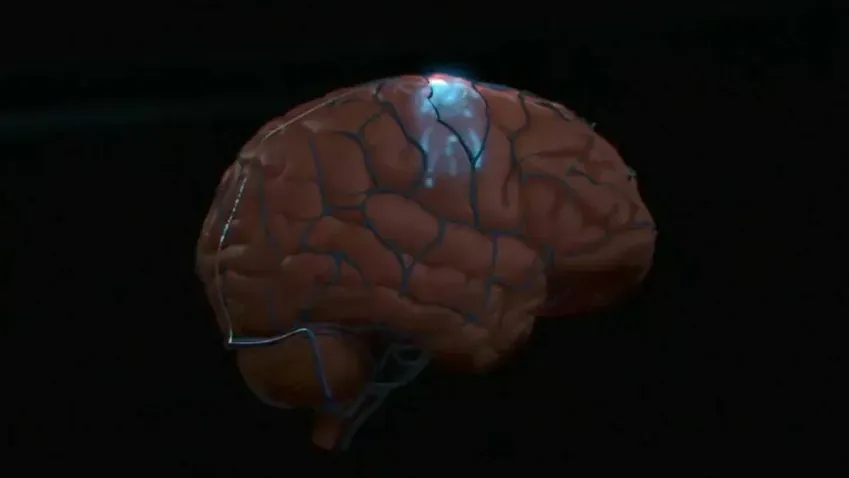 JAMA Neurology: имплантат поможет парализованным людям управлять компьютером