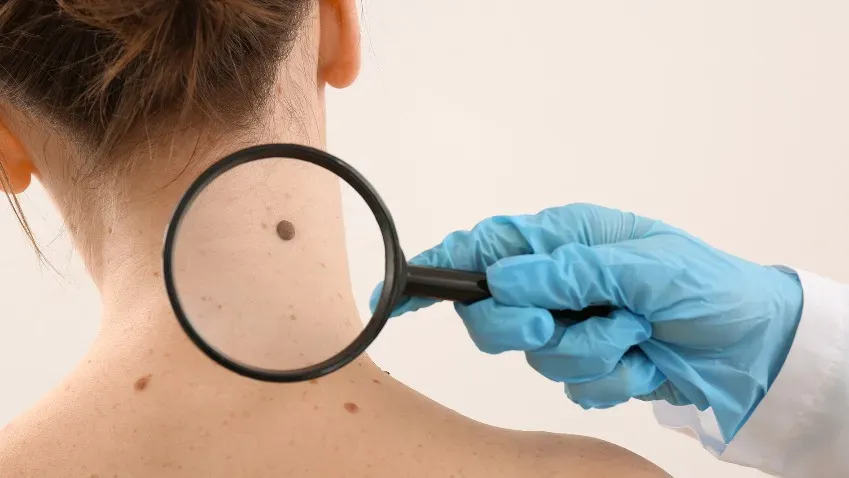 Лимфедема нижних конечностей является фактором риска развития рака кожи