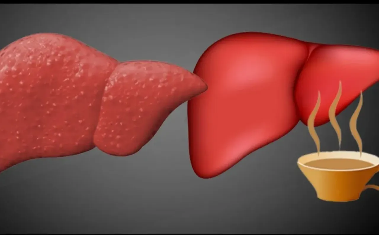 Гепатоз ожирение печени. Диета при жировом гепатозе печени. Жировая дистрофия печени (стеатоз печени). Гепатоз печени можно ли кофе. 1.