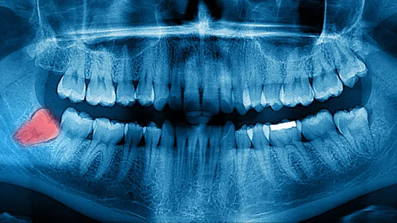 В Индии нейросеть научили определять пол людей по рентгеновским снимкам зубов с точностью 94%