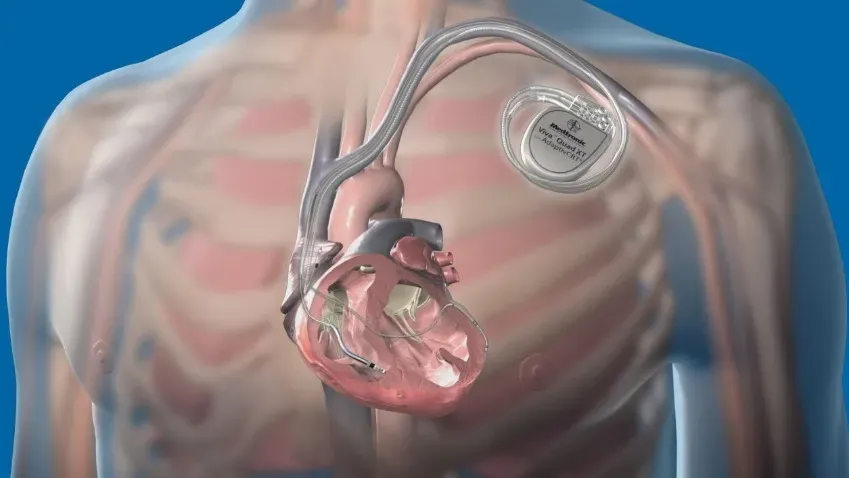 JOTACoC: осложнение кардиостимуляторов у людей с сердечно-сосудистыми заболеваниями в 4 раза...