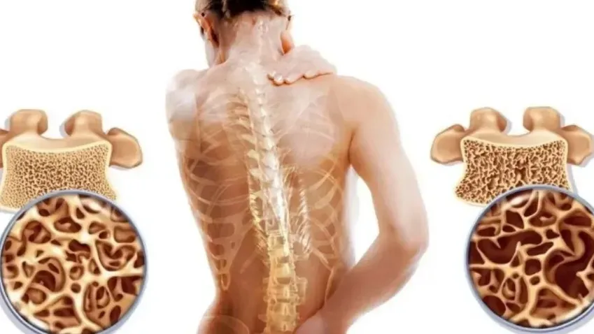 Врач-эндокринолог Елена Губкина перечислила первые признаки остеопороза