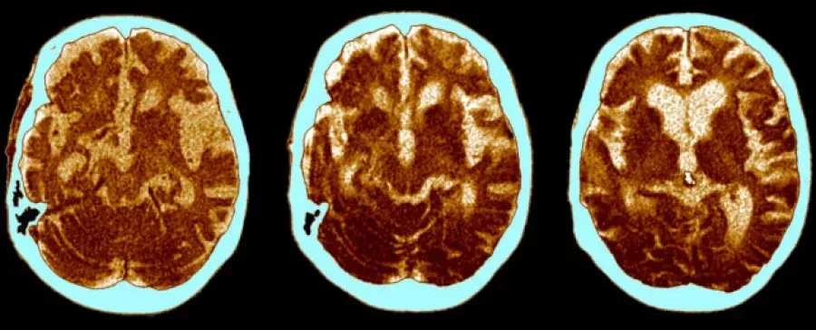 Компьютерная томография головного мозга при болезни Альцгеймера. Источник:...