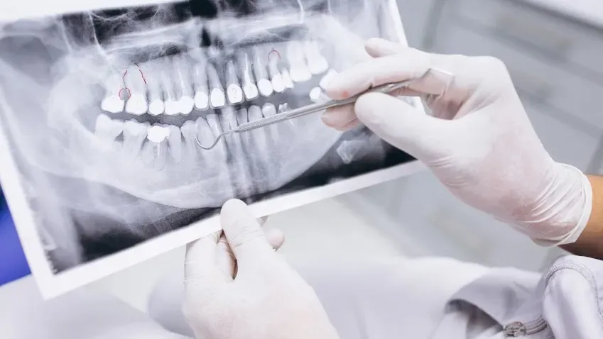 Аиф: Стоматолог Жусев проинформировал о том, что из-за удаление нерва эмаль может стать хрупкой