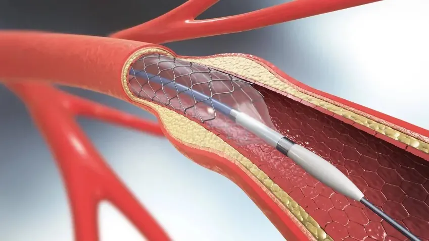 JAMA Cardiology: для пациентов с острым коронарным синдромом стенты с препаратом эверолимус...