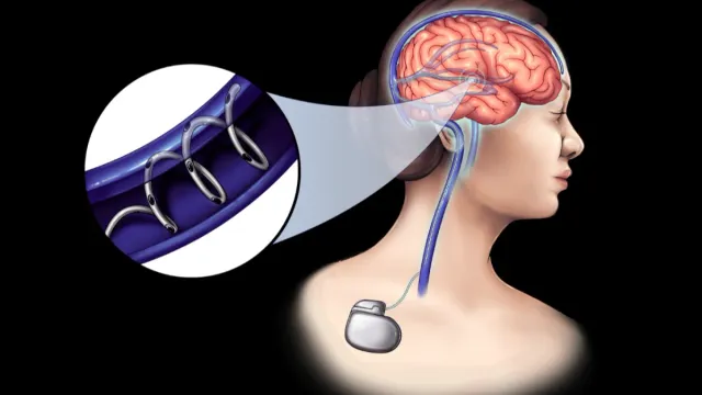 NeuroBionics разработала многофункциональный нейроимплант