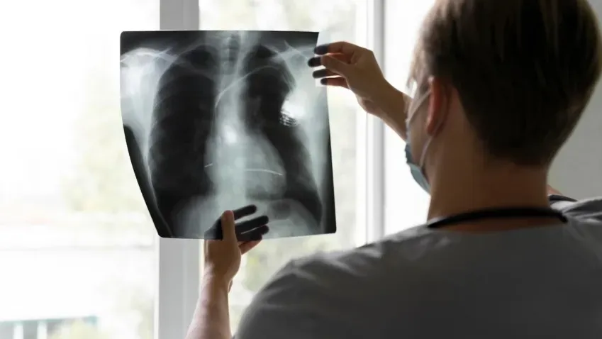 Онколог назвал первые симптомы рака лёгкого