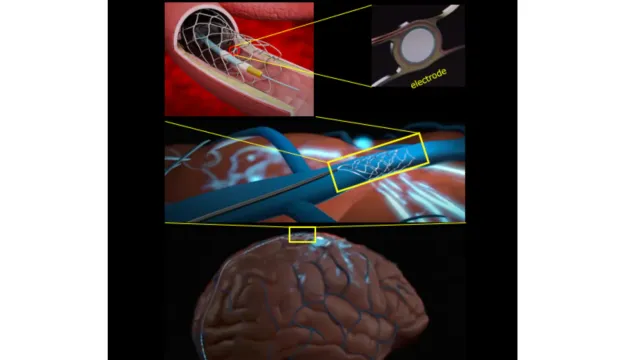 Учёные создали гибкий электрод для мозгово-компьютерного интерфейса