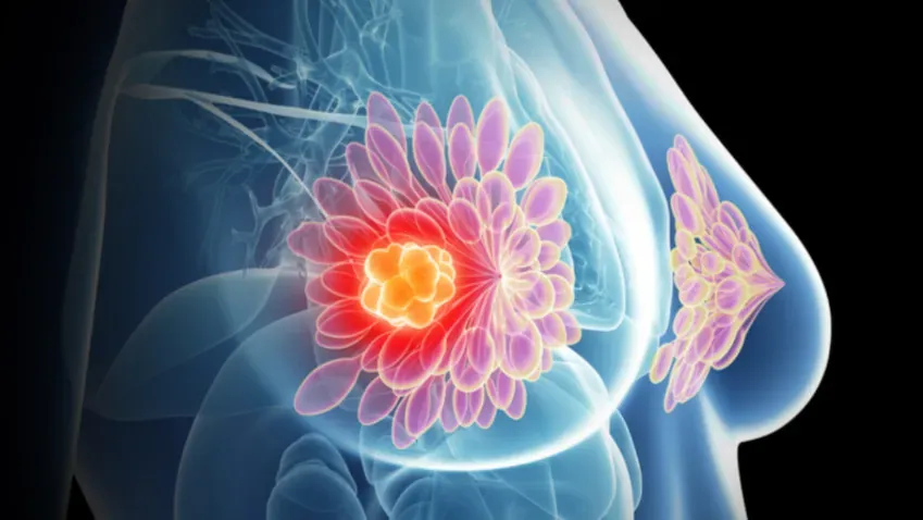 Генетики из БелГУ получили патенты на прогнозирование рака груди