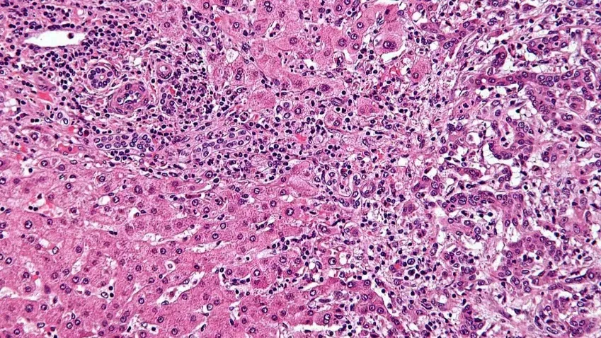 ASCO: препарат Zanidatamab подтвердил свою пользу при лечении рака желчевыводящих путей