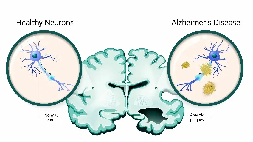Найден новый маркер определения болезни Альцгеймера на ранней стадии