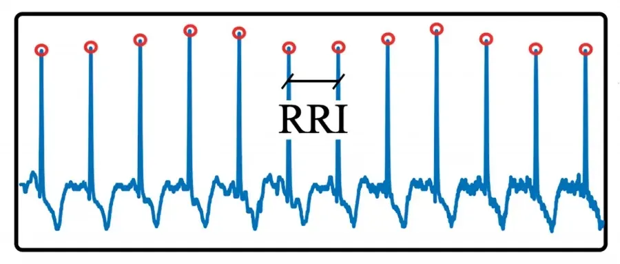 Интервал R-R (RRI) из стандартной ЭКГ, который использовался для обучения ИИ-модели. Источник:...