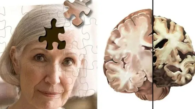 ANC: Найдены отличия людей, устойчивых к болезни Альцгеймера