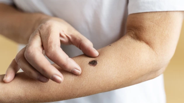 ТАСС: Новая вакцина от рака кожи привела к ремиссии у 77,6% пациентов