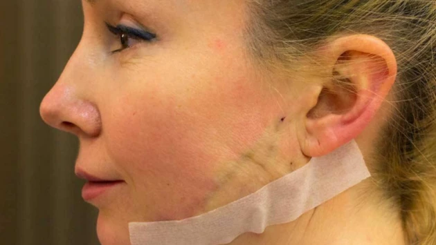 Косметолог Муравина назвала процедуру подтяжки лица золотыми нитями опасной для здоровья