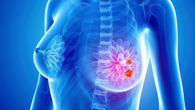 ЦСН: Депрессия у пациенток с раком груди снижает шансы на выздоровление