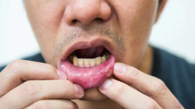Специалисты объясняют: язвы во рту могут быть признаком онкологии