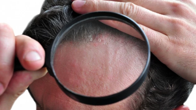 Новый искусственный интеллект умеет отличать псориаз кожи головы от себорейного дерматита
