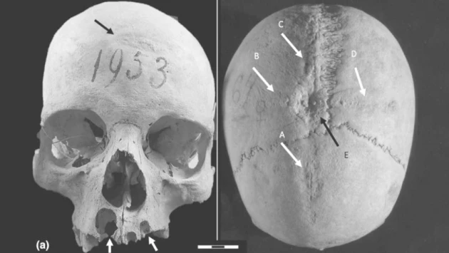 Ученые нашли череп жившей 1300 лет назад знатной лангобардки со следами двух трепанаций