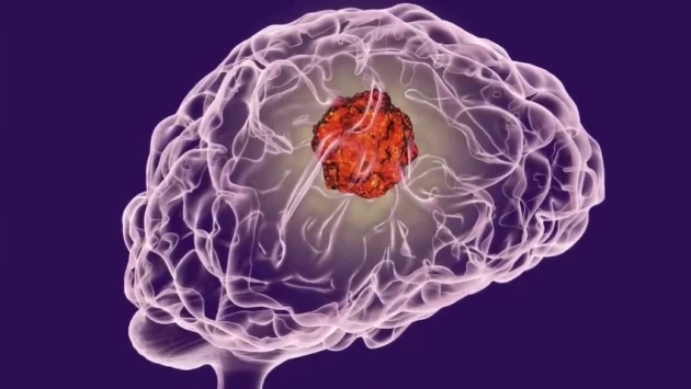 Ученые обнаружили молекулярный маркер, точно предсказывающий рецидив опухоли головного мозга