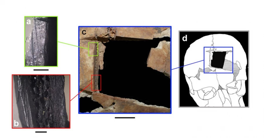 PLOS One: на Армагеддоне нашли 3500-летние останки мужчины с трепанацией черепа