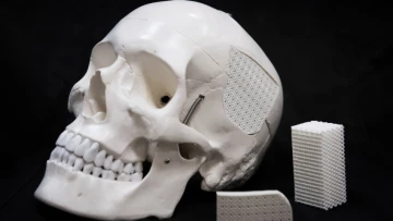 Имплантируемый материал для черепа усовершенствовали российские ученые