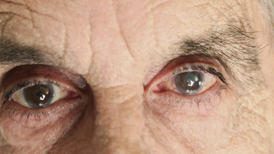 Биологи обнаружили, что частый стресс может повредить зрительный нерв и увеличить риск слепоты