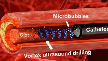 Research: экспериментальное устройство разрушает тромбы с помощью искаженного ультразвука