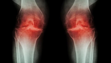 Российские ученые из НИУ ВШЭ создали препарат, замедляющий развитие остеоартрита