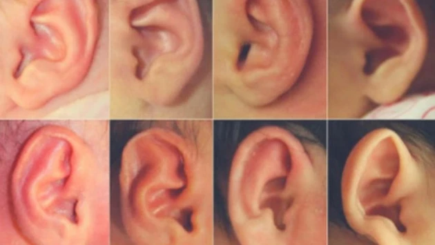 Деформированные уши младенцев можно восстановить с помощью обычных скрепок