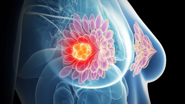 Ученые обнаружили потенциальный метод лечения вторичного рака молочной железы