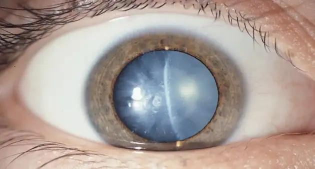 Лечение катаракты выходит на новый уровень