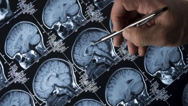 Ученые Университета Цинциннати выявили различия в функциях мозга у пациентов после инсульта