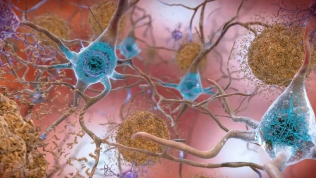 Новое лекарство от болезни Альцгеймера замедляет снижение когнитивных способностей на 35%