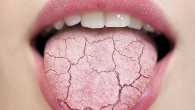 ForPost проинформировал, что сухость во рту может указывать на 5 опасных заболеваний