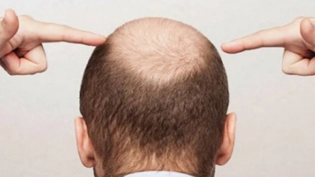 Sport24.ru: из-за чего мужчины лысеют и как остановить выпадение волос
