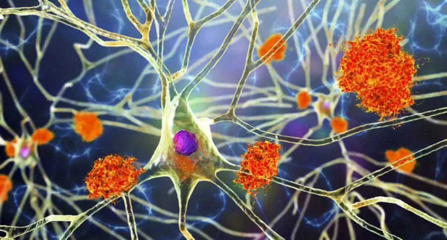 Ученые выяснили, какой ген вызывает риск развития болезни Альцгеймера