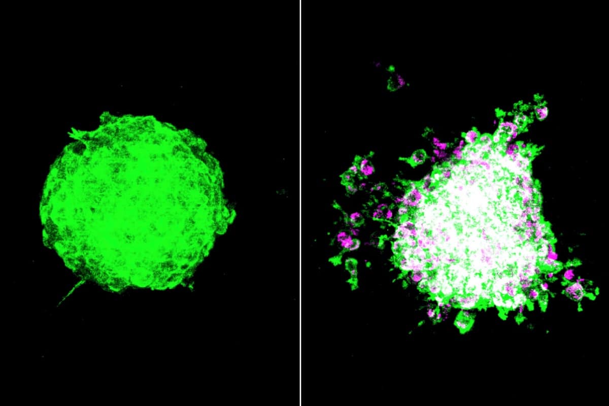 Nature: бактерии помогают раковым клеткам обходить иммунитет человека