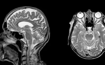 RSNA: аномалии мозга могу быть причиной долгосрочных последствий COVID-19