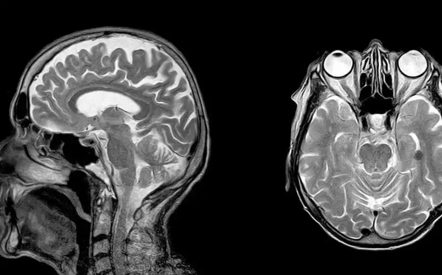 RSNA: аномалии мозга могу быть причиной долгосрочных последствий COVID-19