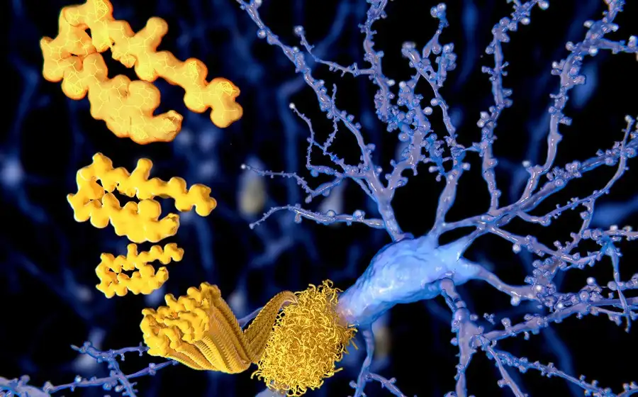 Исследование: синдром Дауна и болезнь Альцгеймера имеют одну и ту же биологию заболевания