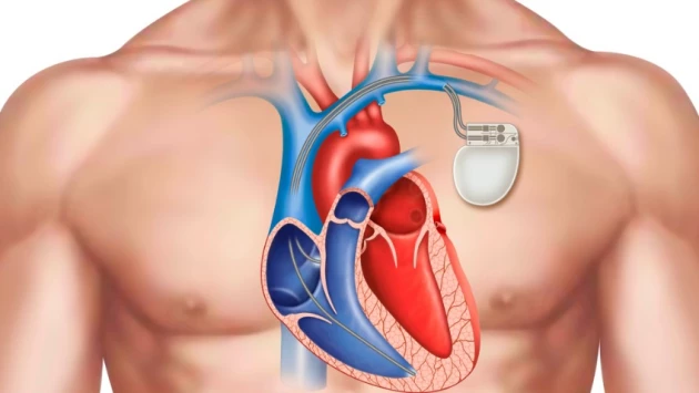 Исследовательская группа разработала имплантируемый беспроводной кардиостимулятор